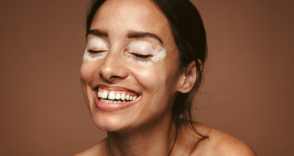 Mancha branca na pele: vitiligo